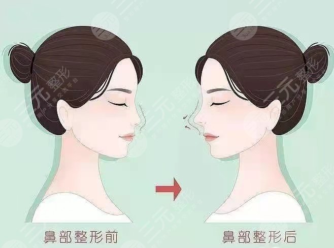 贾大辉做鼻子怎么样