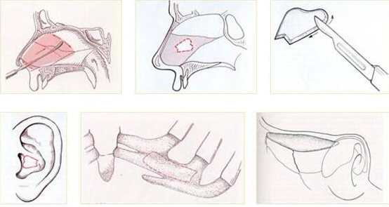 彭绍宗医生隆鼻案例