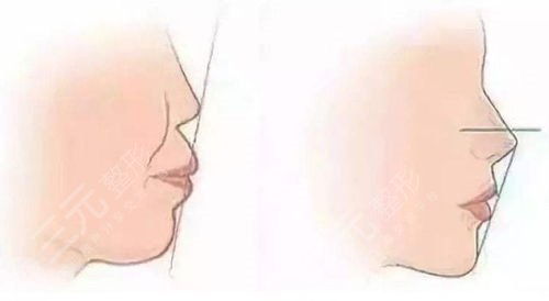 曹栋弼隆鼻图片