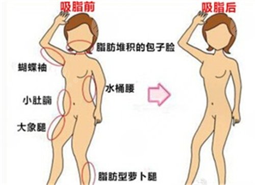 北京焕星医疗美容汪立川吸脂案例