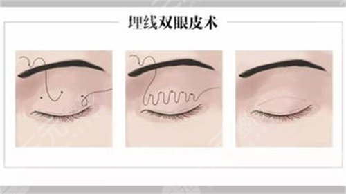 术后三天