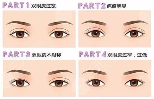 西京医院崔江波医生双眼皮手术后半个月