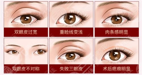 西京医院刘恒鑫双眼皮案例