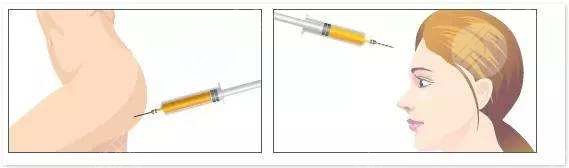 郑楚蓉填充额头案例