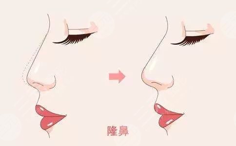 杭州隆鼻专家前十名红榜揭晓，网友说找这10位做准没错的...