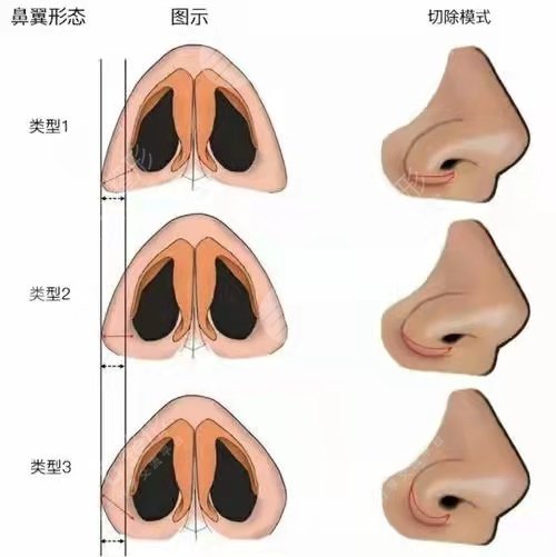西安舒茂国医生鼻翼缩小案例