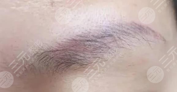 激光洗眉一到七天图片