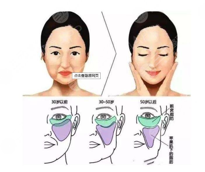 v美减龄后遗症|轻微浮肿别担心!手术原理+术后护理盘点~