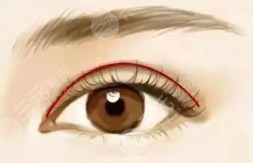 北京彤美刘风卓双眼皮案例