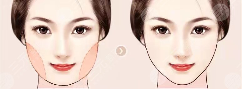 武汉同济冯幼平面部吸脂前