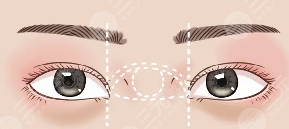 济南中心医院李洋双眼皮怎么样?双眼皮案例