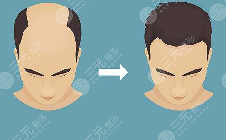 东莞美立方植发医院植发手术经历分享