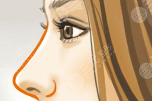 昆山达拉斯刘波肋软骨鼻部手术案例