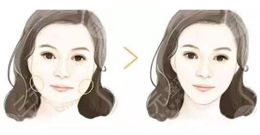 下颌角截骨手术费用多少