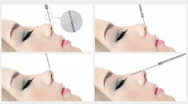 陈振雨医生隆鼻手术术后5天