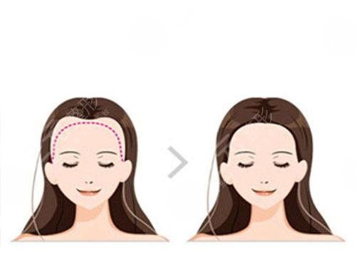 北京中德植发医院发际线改良植发经历分享