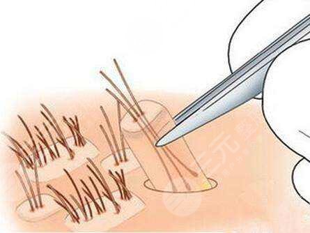 温州大麦微针植发医院脱发种植经历分享