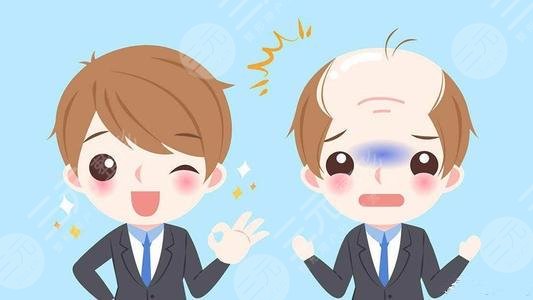 温州大麦微针植发医院脱发种植经历分享