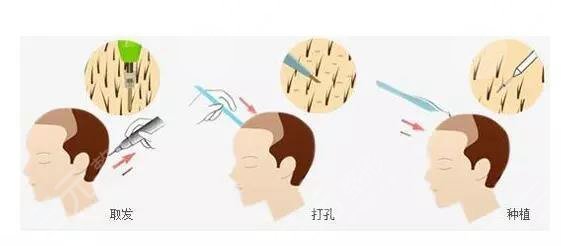 成都恒美植发医院植发手术经历分享