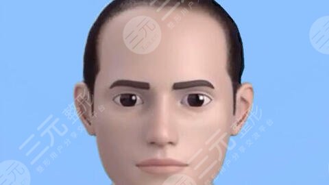杭州美莱医院秃顶植发经历分享