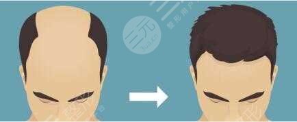 宁波摩范植发医院发际线植发经历分享