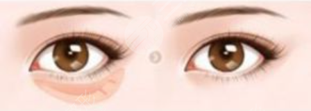 上海臻妮医疗沈莺莺医生去眼袋后