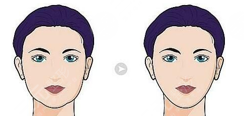 上海整形外科磨骨案例