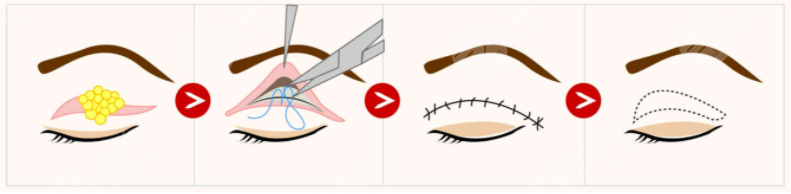 上海沈莺莺割双眼皮前