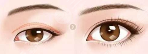 霍玉旺医生双眼皮前