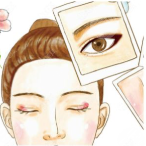 霍玉旺医生双眼皮后28天