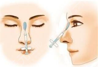 上海整形外科隆鼻案列