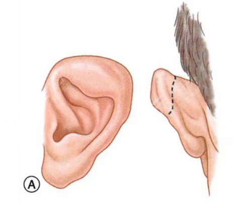 上海整形外科耳朵修复案列