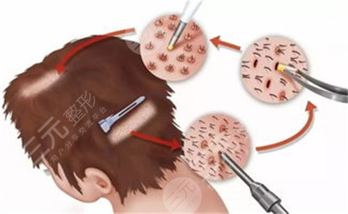 苏州美莱植发医院发际线种植案例分享