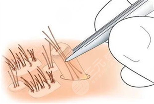 北京壹加壹医疗美容医院发际线种植案例分享