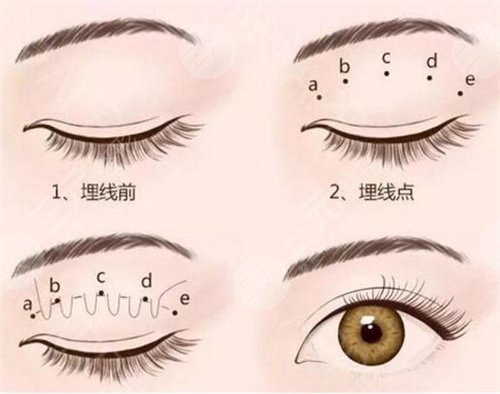 双眼皮修复前