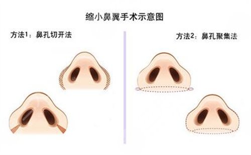 艺星李健兵隆鼻前