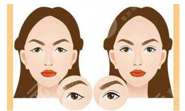 南阳三院王俊英双眼皮案例