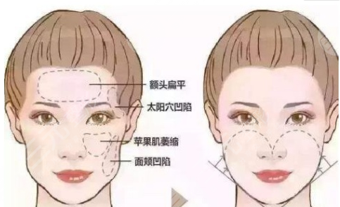 面部填充术前