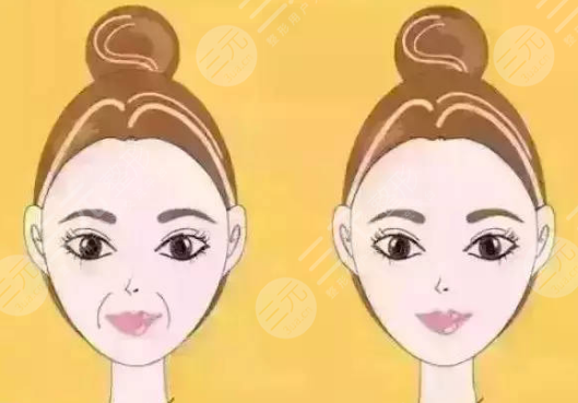 面部填充半个月