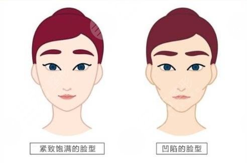 面部填充一个月