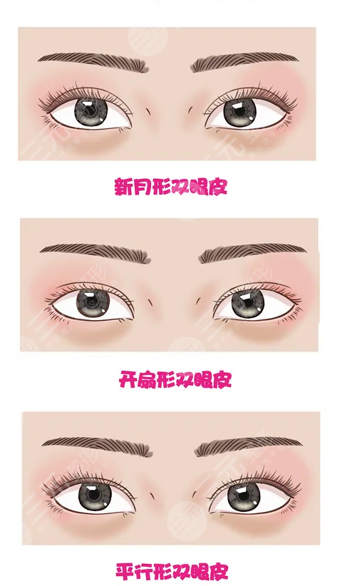 朱迪医生双眼皮案例手术前