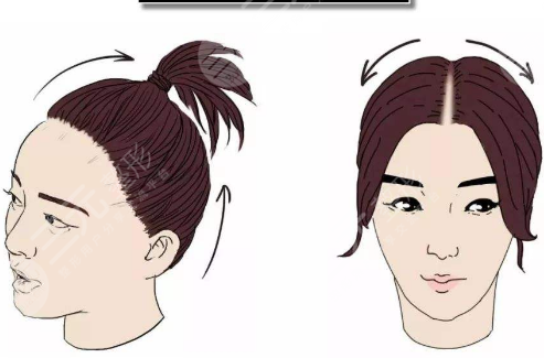 沈阳华美植发医院发际线种植案例