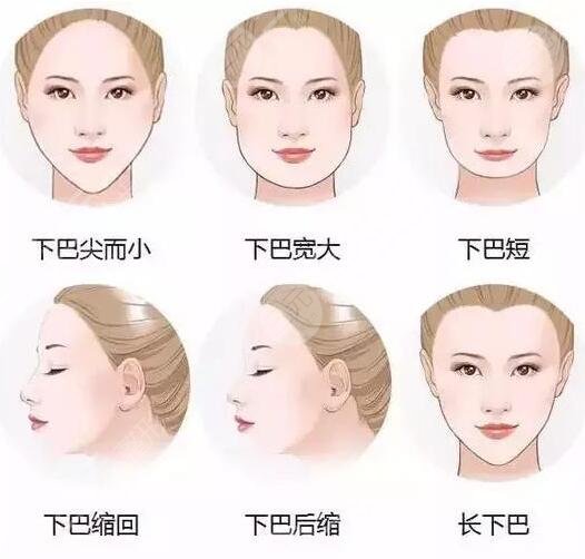 北京联合丽格何照华做下颚骨案例介绍