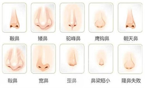 上官文松隆鼻后3个月