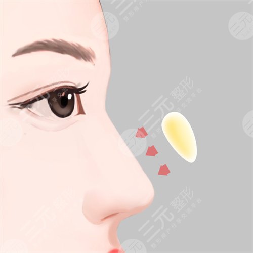 上海李安平肋骨鼻术后1周