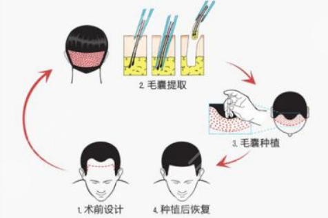 东莞美立方植发中心发际线种植分享