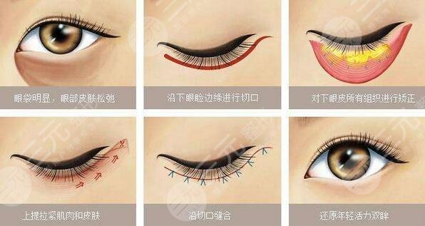 去眼袋是什么意思