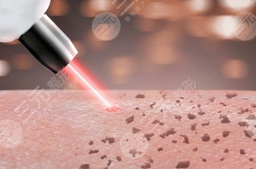 李大铁祛斑好吗?