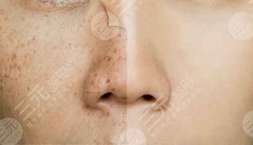 李大铁祛斑好吗?