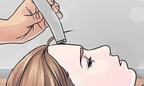 李大铁医生科普激光祛斑